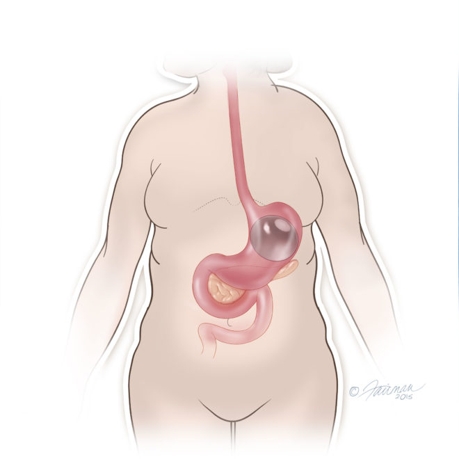 ORBERA-Procedure-Placement-Step-4